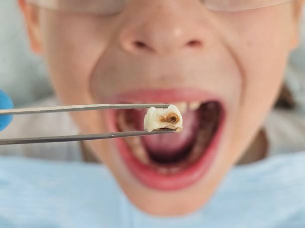 Best Emergency Dentist for Knocked-Out Tooth in Grant City, MO